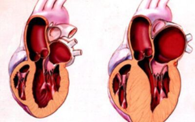 Miocardiopatia Hipertrófica: Guia Definitivo [2024]